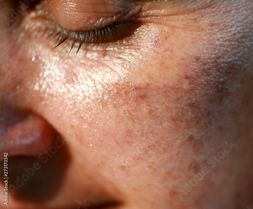 Pigmented spots on the face. Pigmentation on cheeks photo