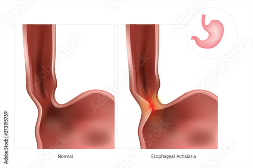 The stomach or esophagus is often referred to as simple Achalasia. The lower esophageal sphincter does not relax, causing inflammation. photo