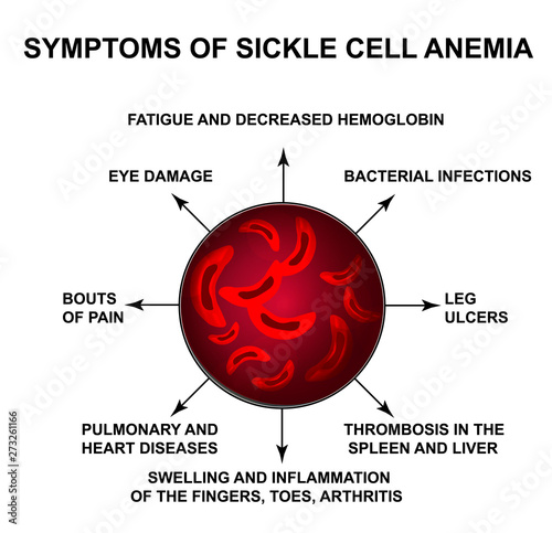 Symptoms of sickle cell anemia. World Sickle Cell Anemia Day 19 June. Red blood cells. Erythrocytes Sickle. Infographics. Vector illustration on isolated background.