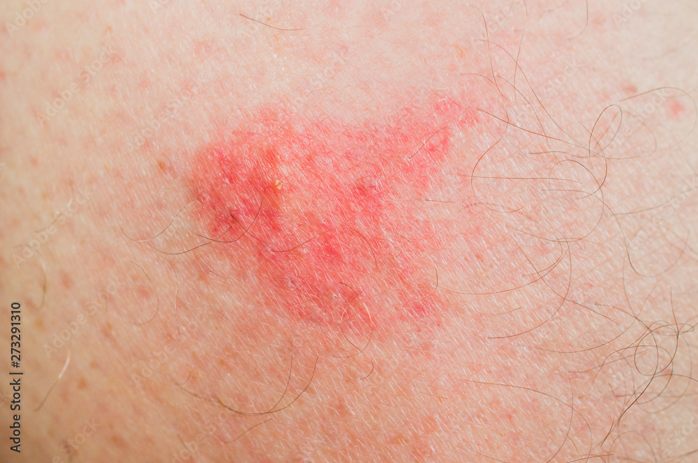 Macro shot of bite of sandfly on a man's leg that caused an allergic reaction Macro shot of bite of sandfly on a man's leg that caused an allergic reaction