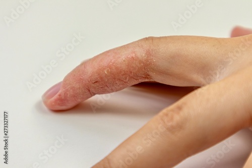 Eczema on finger close up 