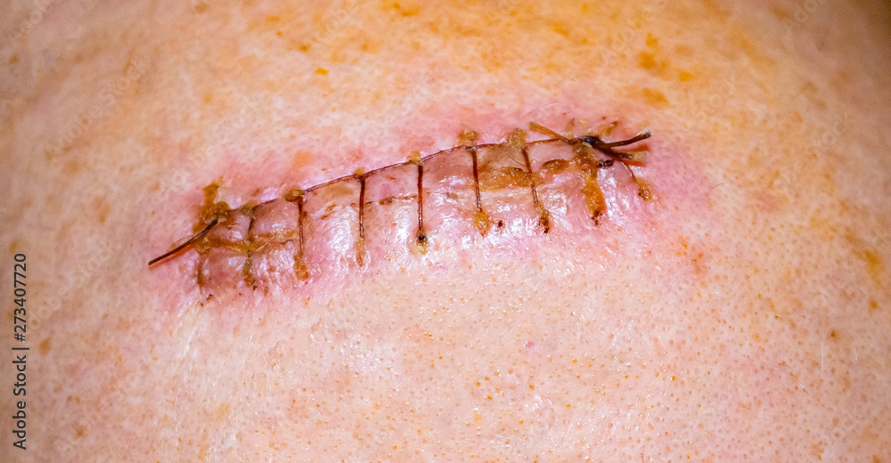 Scar from surgery. Wound scar.The scar on the shoulder.Scar with thread.
