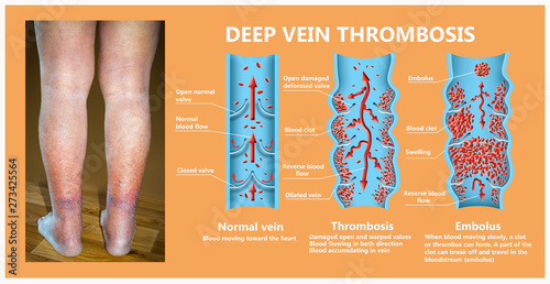 Close-up of skin with varicose veins