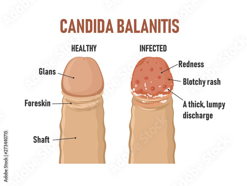 Foto Candida balanitis. Healthy penis and infected