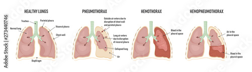 Human lungs with pneumothorax, hemothorax and hemopneumothorax photo