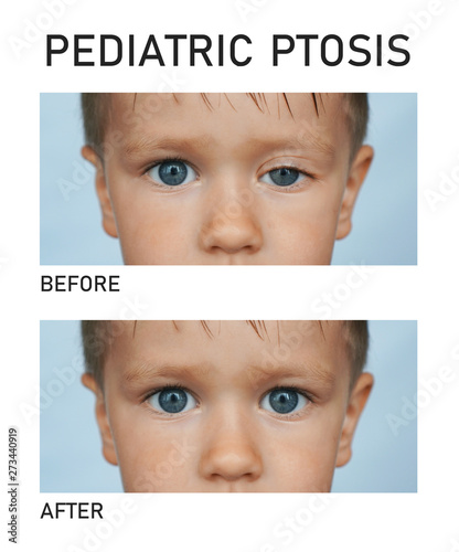 Cuadro en lienzo Pediatric ptosis