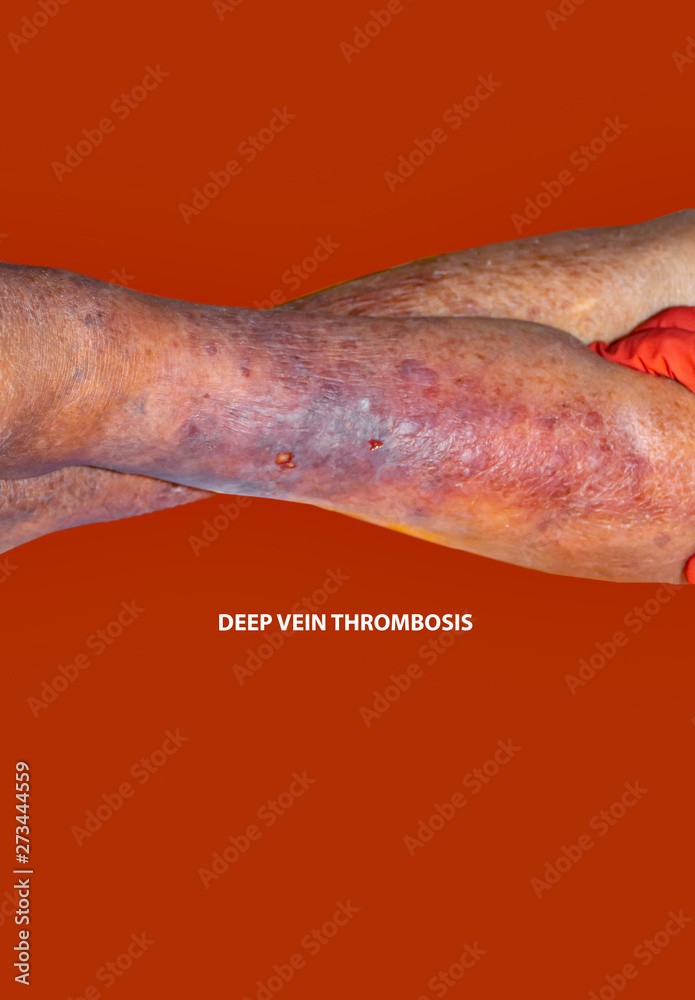 Fototapeta premium Close-up of skin with varicose veins