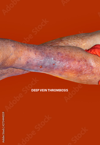 Close-up of skin with varicose veins