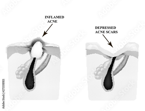 Inflamed acne on the skin. Inflamed pimple. The structure of the skin. Acne scar.