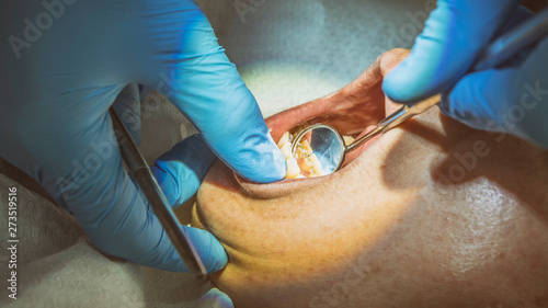 Close Up Shot Of Dentist Examining Teeth