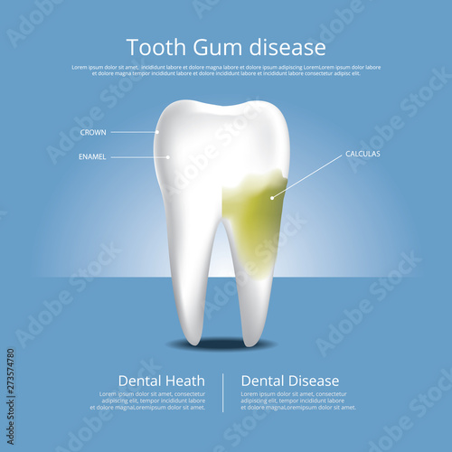 Human teeth Stages of Gum Disease Vector Illustration
