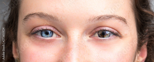 Human heterochromia iridium, woman eyes showing difference in coloration