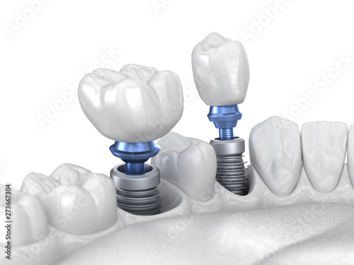 Premolar and Molar tooth crown installation over implant - white concept. 3D illustration of human teeth and dentures