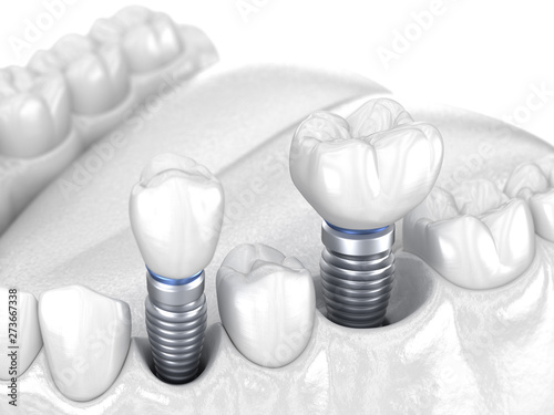 Premolar and Molar tooth crown installation over implant - white concept. 3D illustration of human teeth and dentures