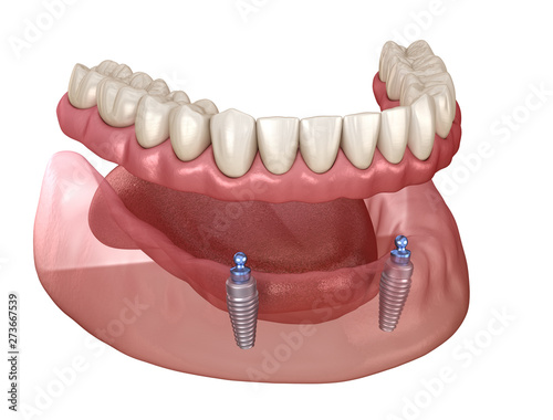 Obraz na plátně Mandibular removable prosthesis All on 2 system supported by implants with ball attachments