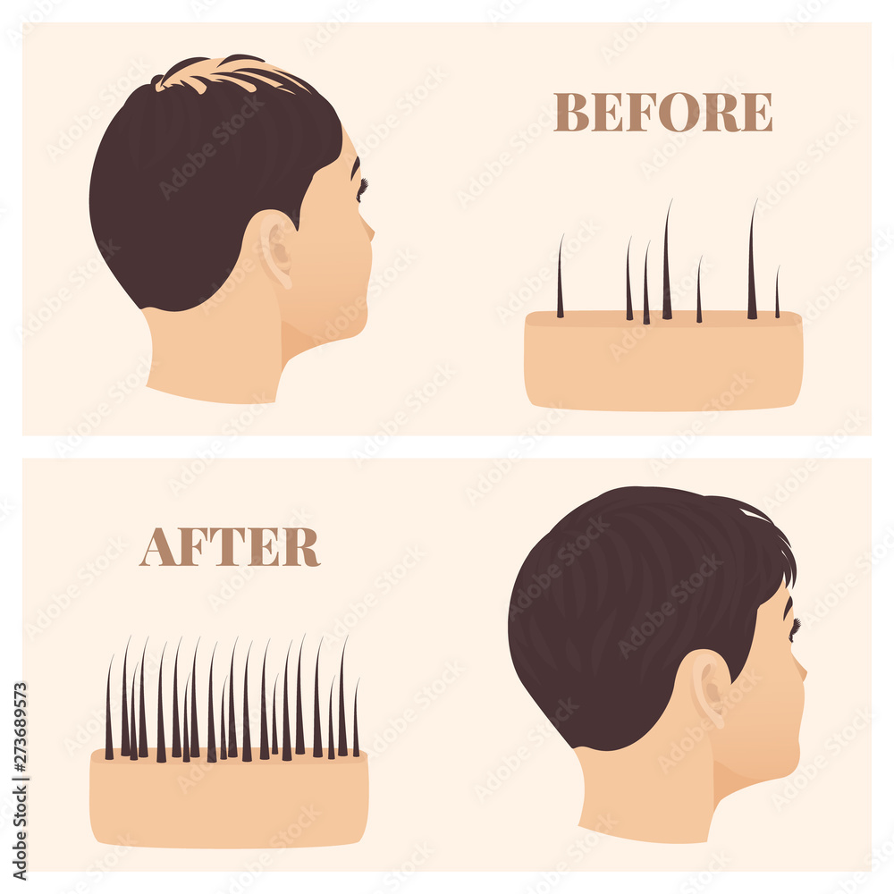 Woman with thinning hair before and after hair loss restoration. Female pattern baldness set with skin cross-section diagram. Treatment result in side view. Alopecia infographics medical vector. Stock Vector | Adobe Stock Woman with thinning hair before and after hair loss restoration. Female pattern baldness set with skin cross-section diagram. Treatment result in side view. Alopecia infographics medical vector. Stock Vector | Adobe Stock