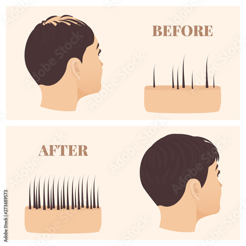 Woman with thinning hair before and after hair loss restoration. Female pattern baldness set with skin cross-section diagram. Treatment result in side view. Alopecia infographics medical vector.