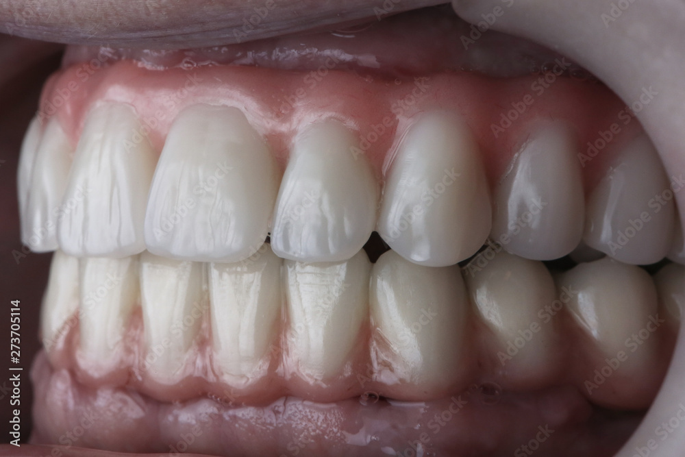 established dental dentures made of polymer and artificial gums, patient's upper and lower jaw