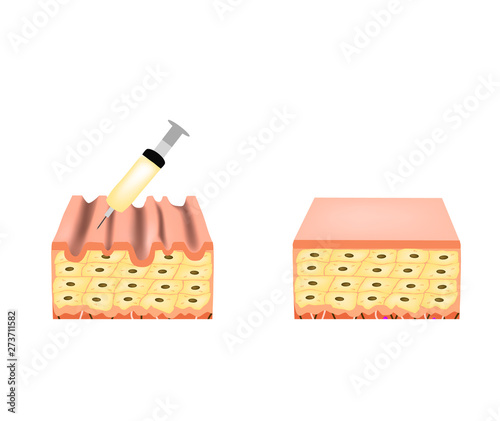 Wrinkles on the skin. Botox wrinkle treatment. Anatomical skin structure. Botox injection. Infographics. Vector illustration on isolated background.