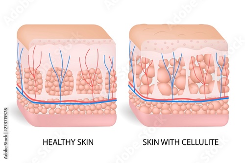 Illustration of skin cross section showing cellulite. The formation of cellulite. Cellulite occurs in most females and rarely in males. Vector diagram isolated on white background. photo