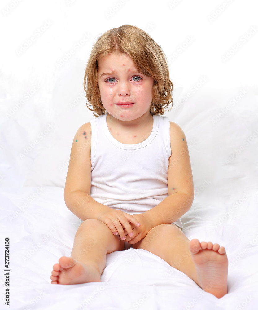Chickenpox in a 3 year old boy. Portrait, long hair, white clothes, background Chickenpox in a 3 year old boy. Portrait, long hair, white clothes, background