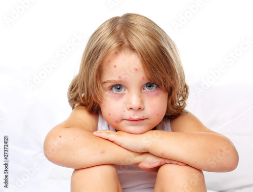 Chickenpox in a 3 year old boy. Portrait, long hair, white clothes, background