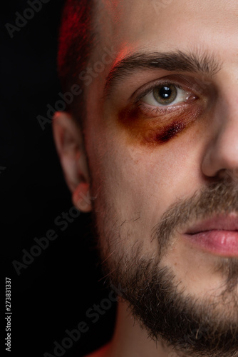 Man portrait with bruise eye