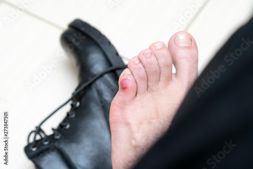 Bloody terrible blister on human feet with new black leather shoes laying around