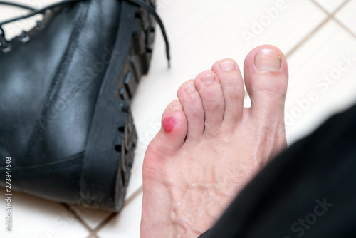 Bloody terrible blister on human feet with new black leather shoes laying around Fototapeta
