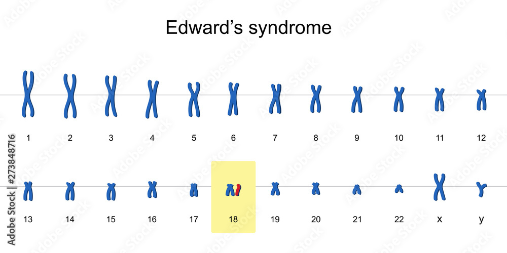 Edward's syndrome karyotype vector ESP10 Stock Vector Adobe Stock