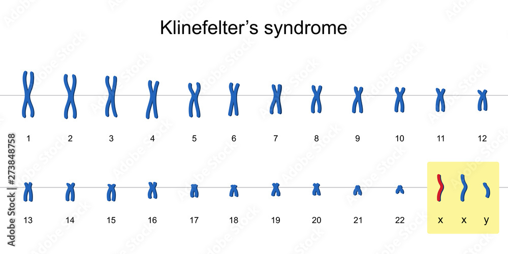 Klinefelter's syndrome karyotype Stock Vector | Adobe Stock