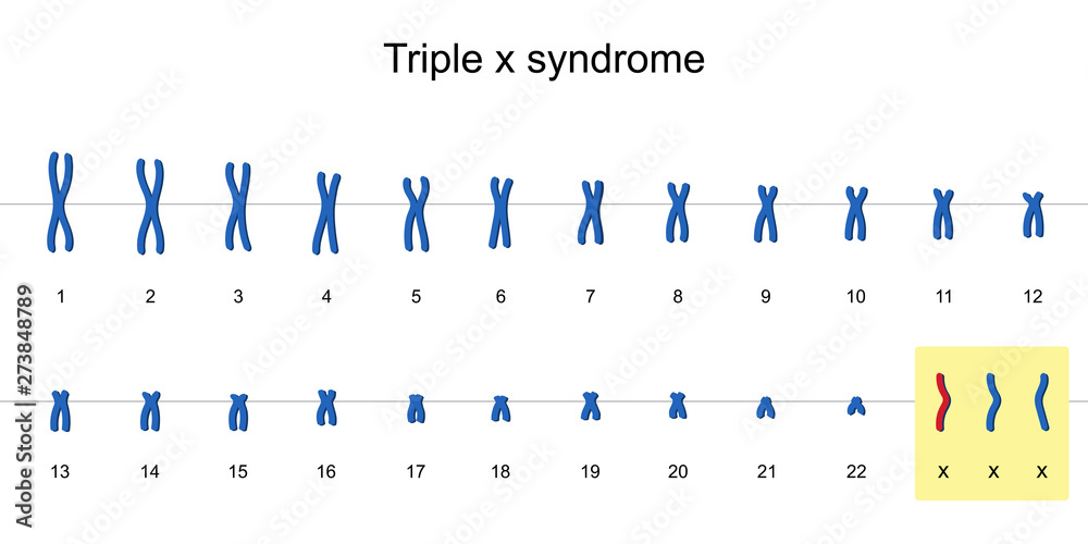 Triple x syndrome karyotype vector ESP10 Stock Vector Adobe Stock