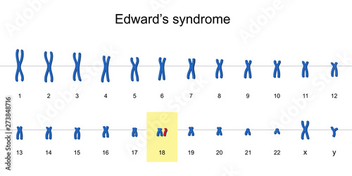 Edward's syndrome karyotype vector ESP10