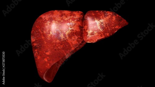 Stage of a Liver to the patient because of diseases like greasy, liver fibrosis, cirrhosis, hepatitis and cancer photo