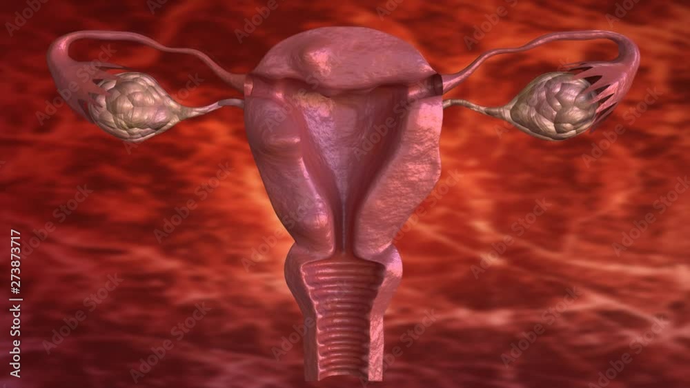 uterine fibroid are benign solid tumors formed by muscle tissue. Its size can vary greatly and some cause large abdomen increase