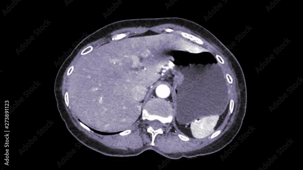 CT Upper Abdomen axial view with injection contrast media for detect liver disease or HCC. CT Upper Abdomen axial view with injection contrast media for detect liver disease or HCC.