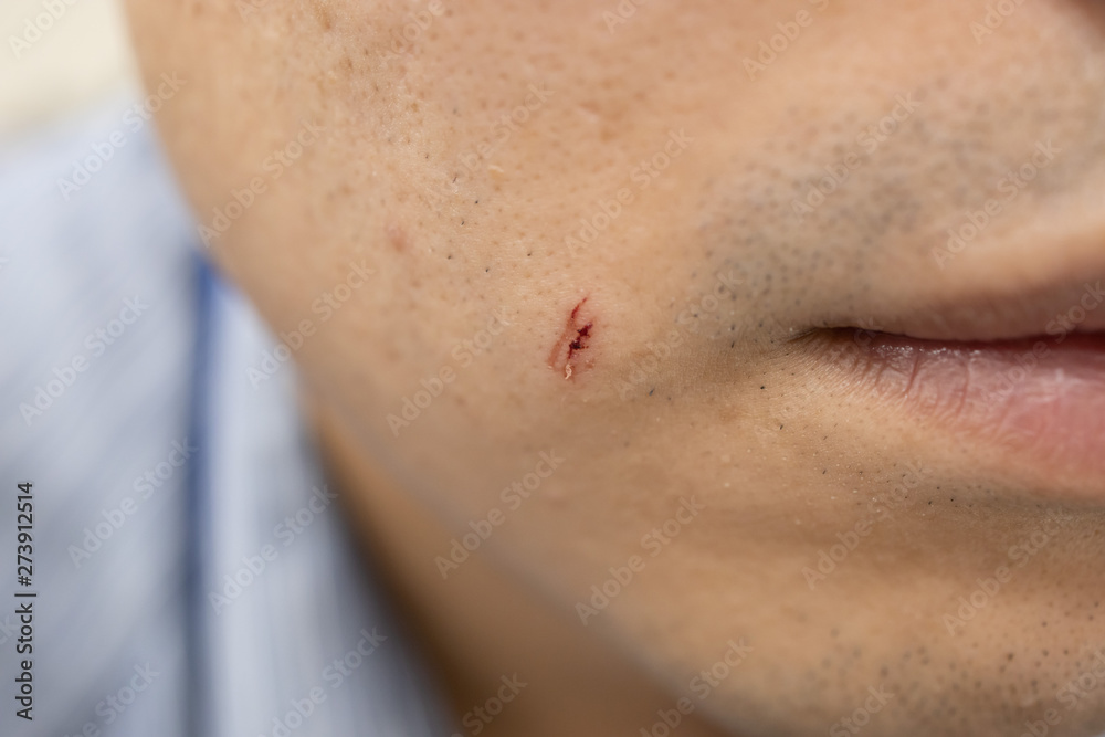 small wound on a man face from razor Stock Photo | Adobe Stock