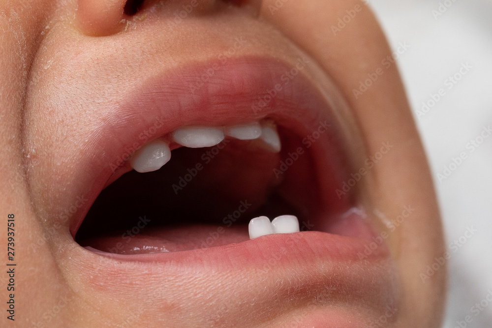 Fototapeta premium The mouth of a crying child is viewed closeup, open lips reveal milk small milk teeth. Oral health of preschool children.