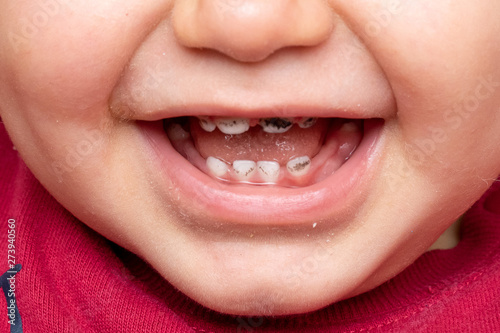 Foto A closeup view on the mouth of a smiling toddler, open lips reveal black spotted milk teeth