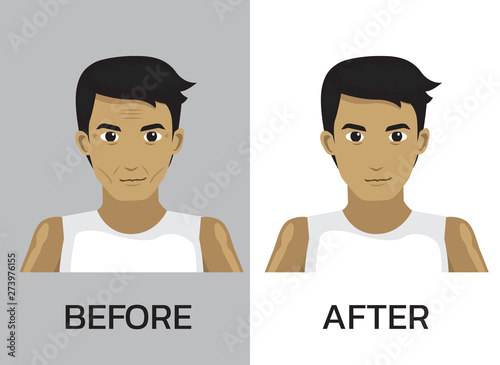 Botox Before After Face Manga Man Cartoon Vector Illustration