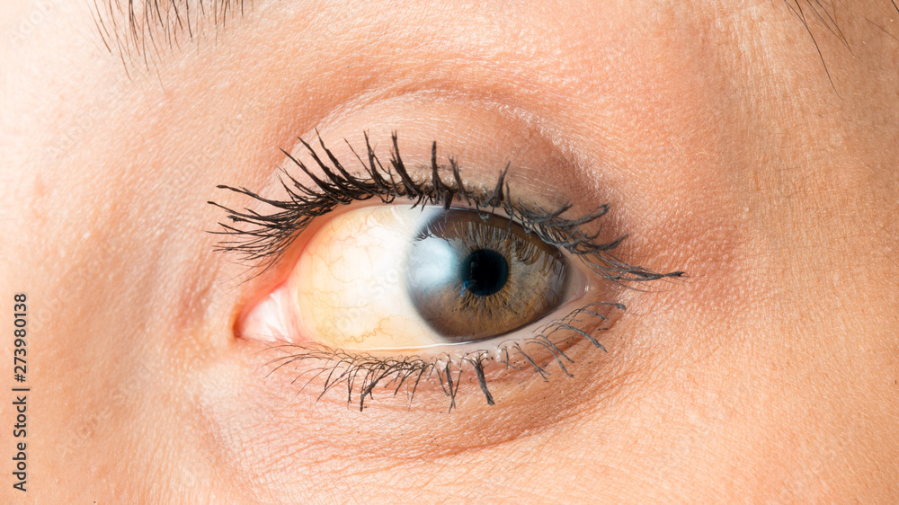 Eye with jaundice that shows yellowing of the sclera Stock Photo