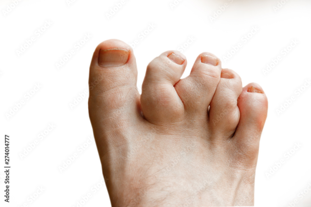 Rheumatoid polyarthritis on the toes, white background. valgus deformity of the toes with pathologic fractures - obrazy, fototapety, plakaty 