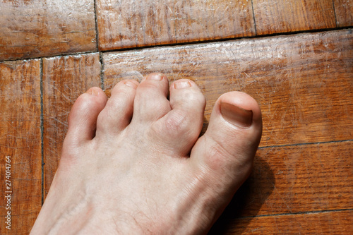 curvature of the toes caused by Ollier disease, which is a rare nonhereditary sporadic disorder where intraosseous benign cartilaginous tumors (enchondroma) develop close to growth plate cartilage. photo