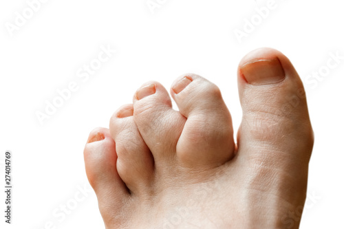 close-up of deformation of the toes caused by Rheumatoid polyarthritis on foot of a young man, white background. valgus deformity of the toes with pathologic enchondromas. Hallux valgus photo