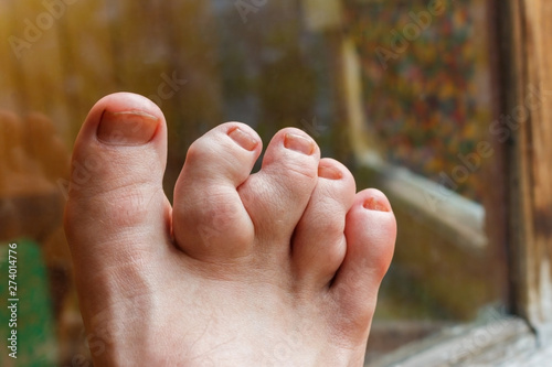Maffucci syndrome of the toes with tumors of bone and soft tissue. The deformity cause foot pain and cosmetic concern. Painful gout inflammation on toe joints. photo