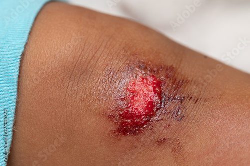 A close-up view of a fresh flesh wound on the knee of an infant. Details of a bleeding and painful leg wound after falling over and grazing knees.