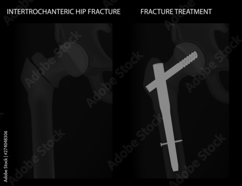 Vector illustration hip joint problem, x-ray of intertrochanteric hip fracture treatment with a hip nail and a screw. For advertising and medical publications.