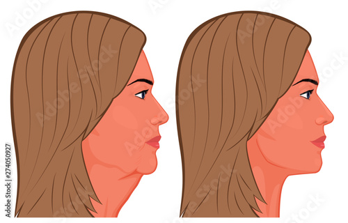 Vector illustration. A female face before, after plastic surgery - facial rejuvenation, face lift. Close up view. For advertising of cosmetological procedures, medical and beauty publications. EPS 10.