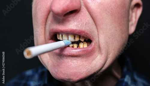Cigarette in the man's mouth. Plaque teeth cavities and paradontosis. Smoking causes dental decay problems and bad smile. Dentist treatment concept. Harmful habit.