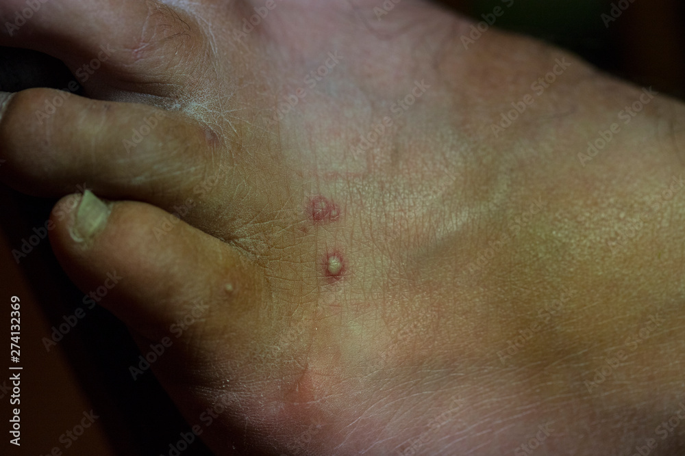 Fototapeta premium Fire Ant Bite Marks